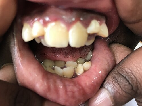 過剰歯